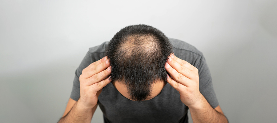 تشخيص وعلاج الثعلبة الأندروجينية
